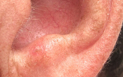 De las complicaciones de la vejez esta es la más traicionera